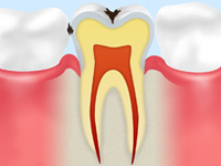 エナメル質のむし歯 