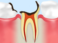 歯根のむし歯