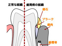 歯磨きをすると歯ぐきから血が出る歯ぐきが腫れている歯がグラグラする