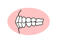 上下の歯が前に突き出ている（上下顎前突）